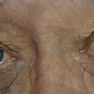 Life Biosciences is starting a clinical trial of its cellular reprogramming therapy in humans